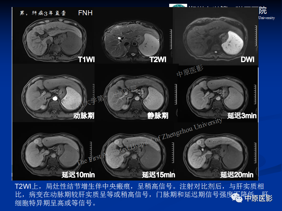 影像PPT - 【病例】肝脏结节性肝硬化1例MR影像-13