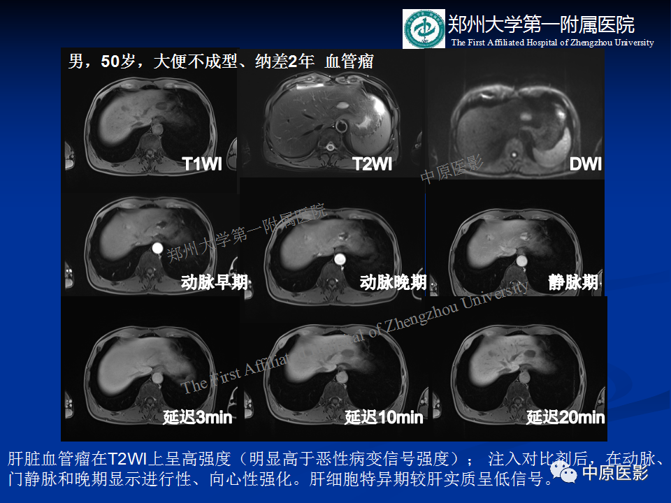 影像PPT - 【病例】肝脏结节性肝硬化1例MR影像-14