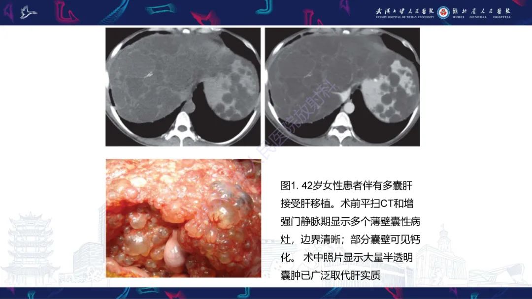 影像PPT - 【PPT】肝脏多房囊性病变影像诊断-4