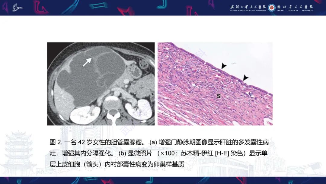 影像PPT - 【PPT】肝脏多房囊性病变影像诊断-7