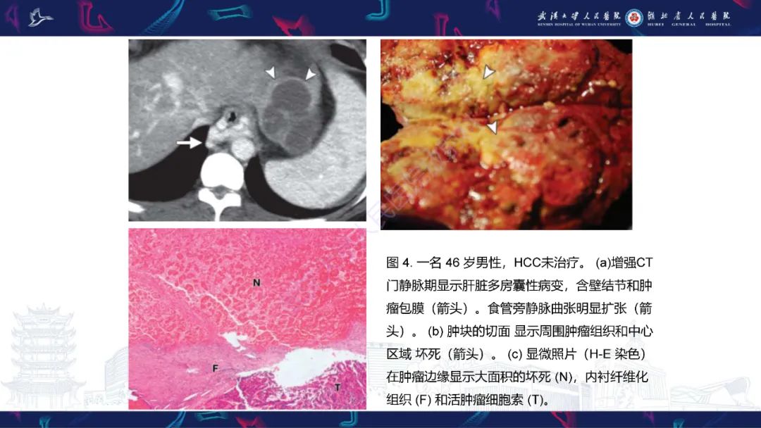 影像PPT - 【PPT】肝脏多房囊性病变影像诊断-9