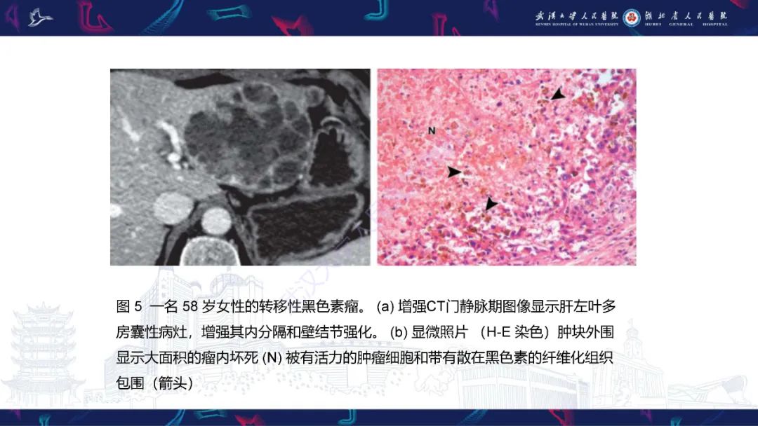影像PPT - 【PPT】肝脏多房囊性病变影像诊断-14