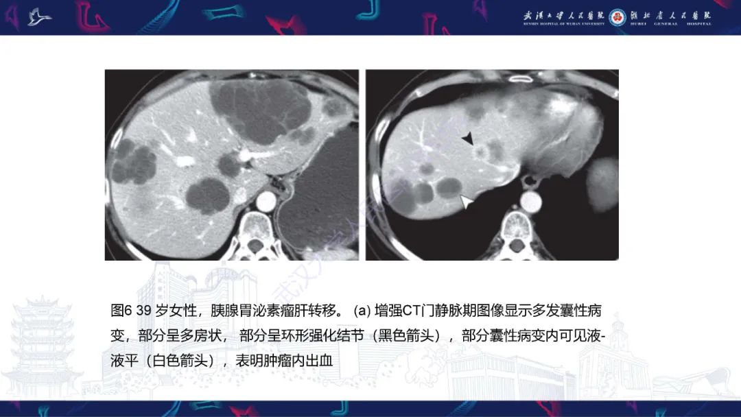影像PPT - 【PPT】肝脏多房囊性病变影像诊断-15