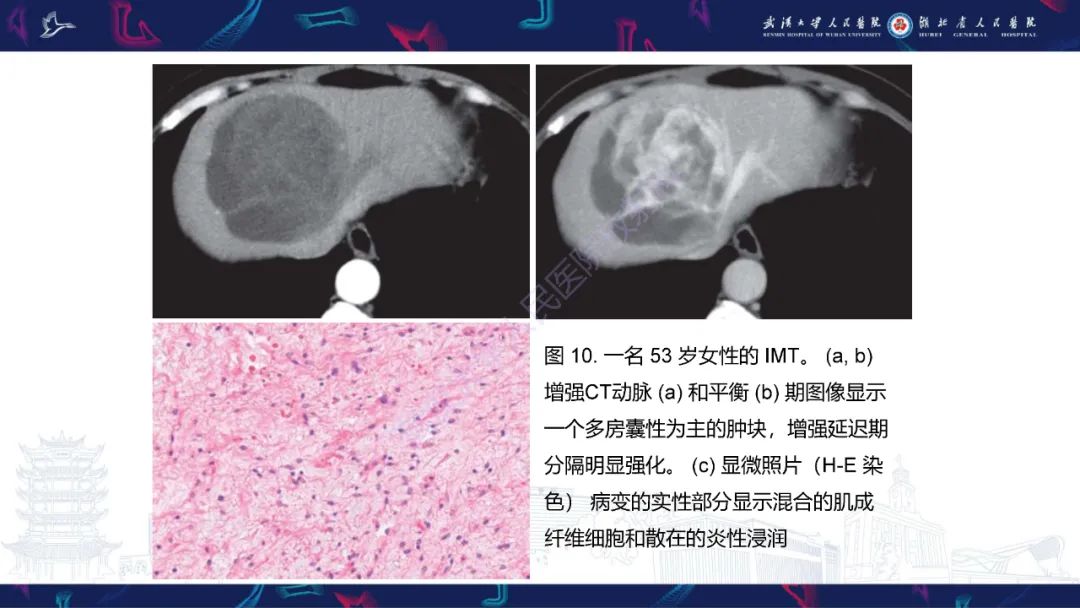 影像PPT - 【PPT】肝脏多房囊性病变影像诊断-20