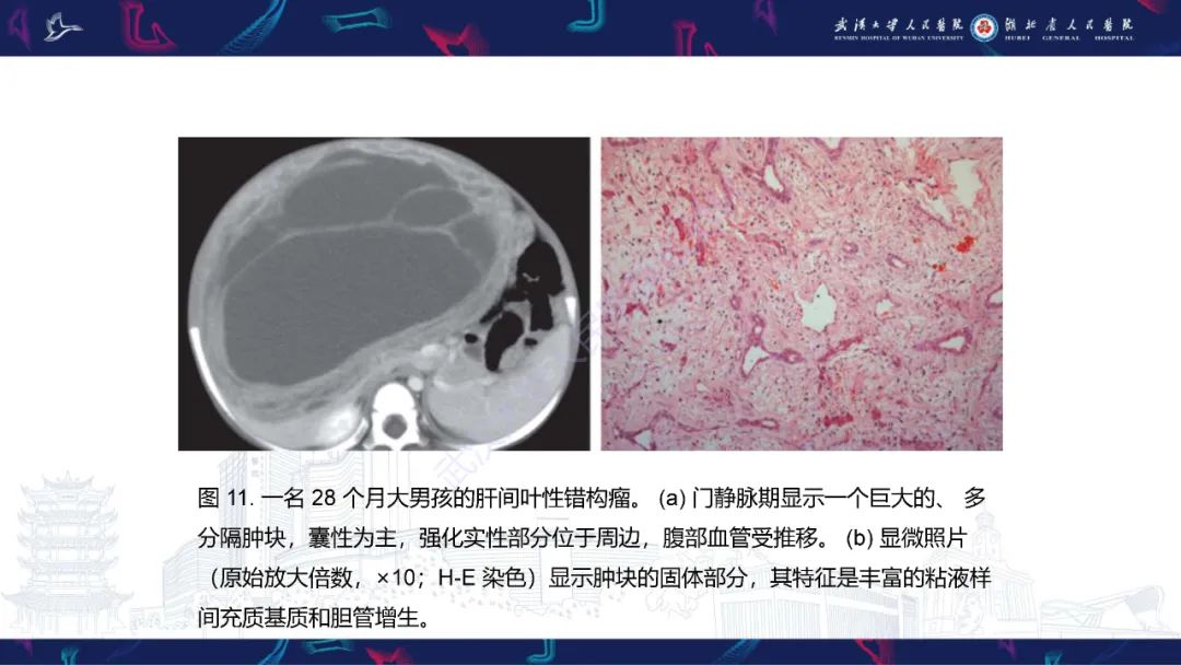 影像PPT - 【PPT】肝脏多房囊性病变影像诊断-22