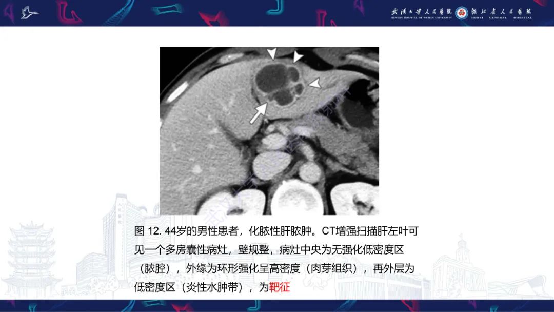 影像PPT - 【PPT】肝脏多房囊性病变影像诊断-24