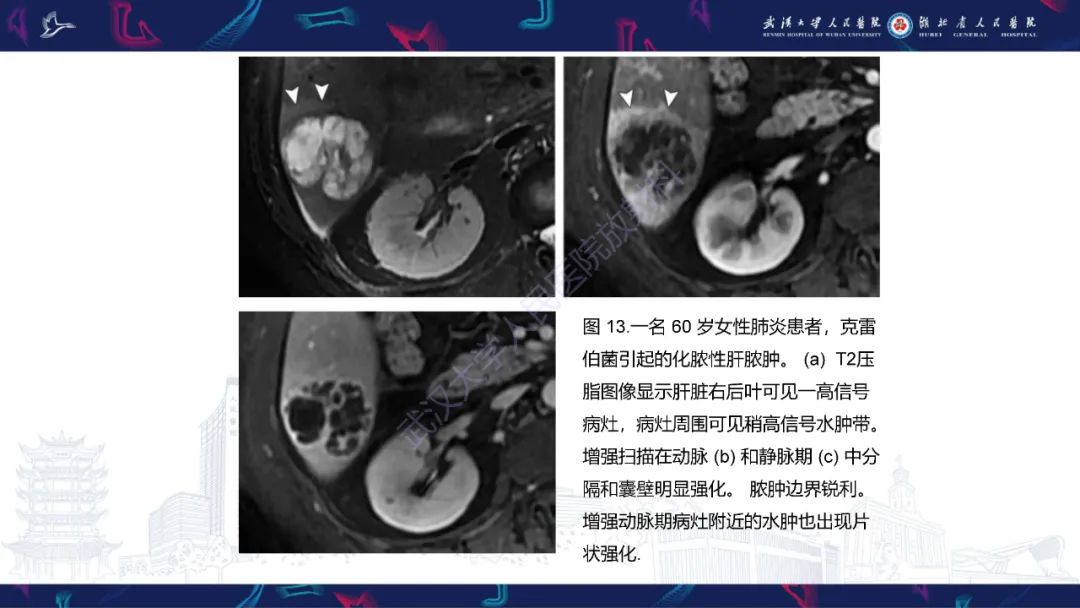 影像PPT - 【PPT】肝脏多房囊性病变影像诊断-25