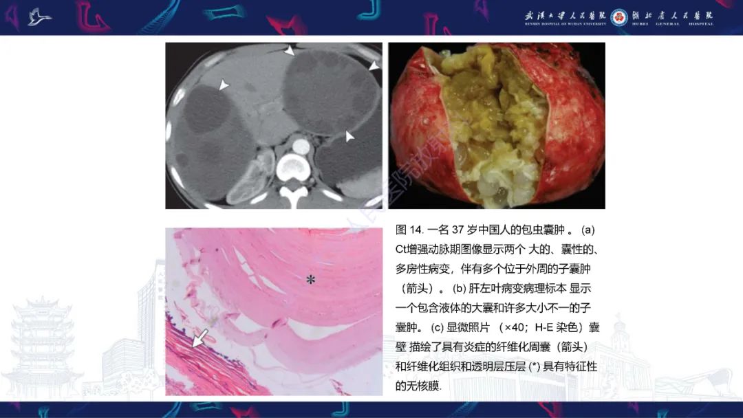 影像PPT - 【PPT】肝脏多房囊性病变影像诊断-27