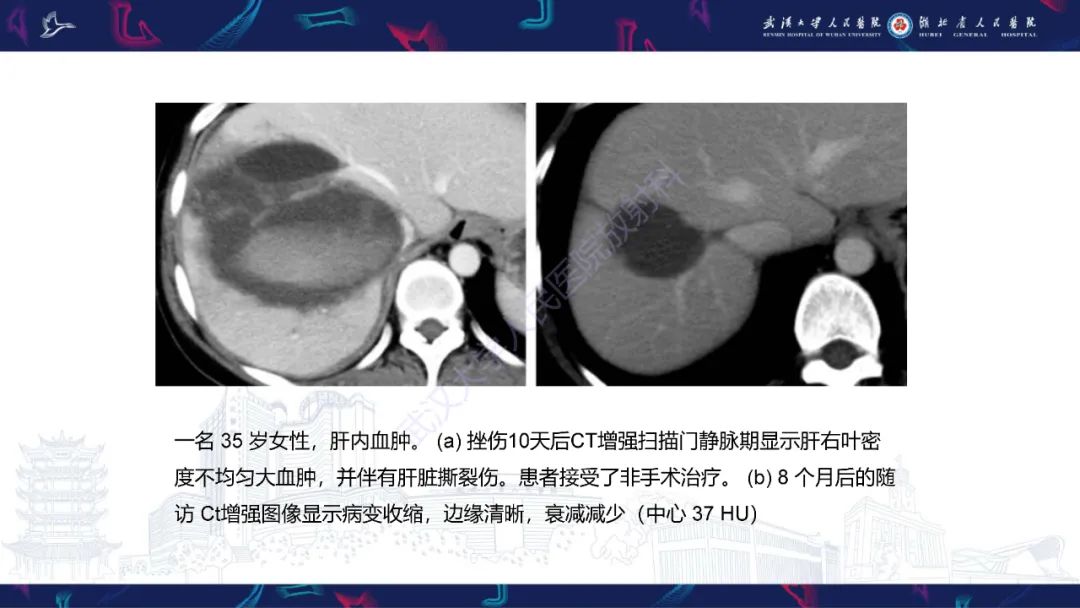 影像PPT - 【PPT】肝脏多房囊性病变影像诊断-29
