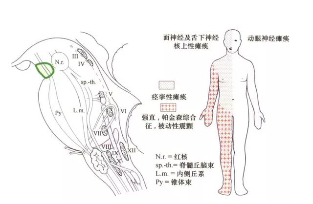 影像PPT - 10大常见脑干综合征-1 影像PPT - 10大常见脑干综合征-1