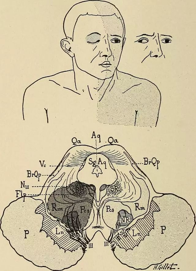 影像PPT - 10大常见脑干综合征-4 影像PPT - 10大常见脑干综合征-4
