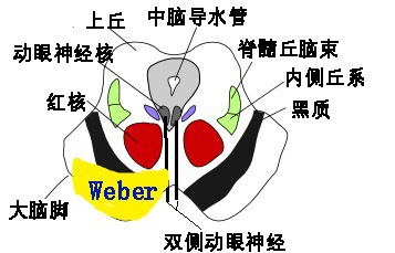 影像PPT - 10大常见脑干综合征-3 影像PPT - 10大常见脑干综合征-3
