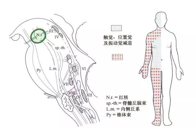 影像PPT - 10大常见脑干综合征-6 影像PPT - 10大常见脑干综合征-6