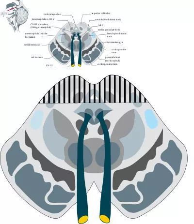 影像PPT - 10大常见脑干综合征-9 影像PPT - 10大常见脑干综合征-9