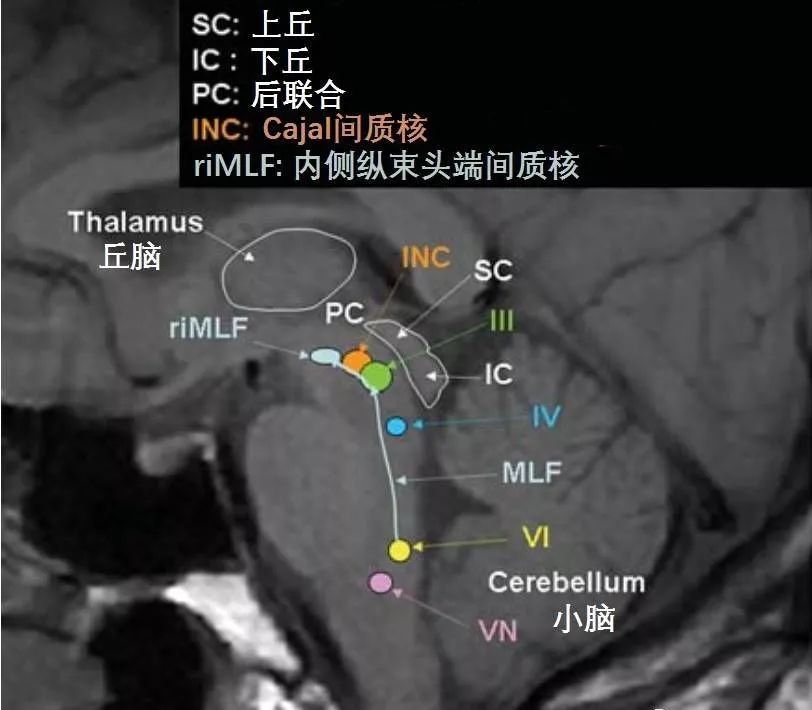 影像PPT - 10大常见脑干综合征-10