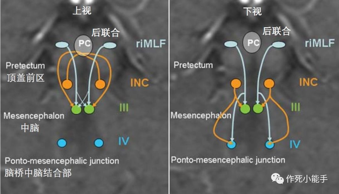 影像PPT - 10大常见脑干综合征-11 影像PPT - 10大常见脑干综合征-11