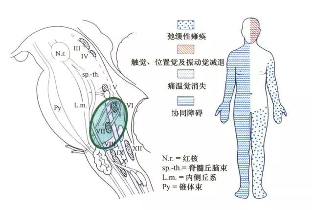 影像PPT - 10大常见脑干综合征-18 影像PPT - 10大常见脑干综合征-18
