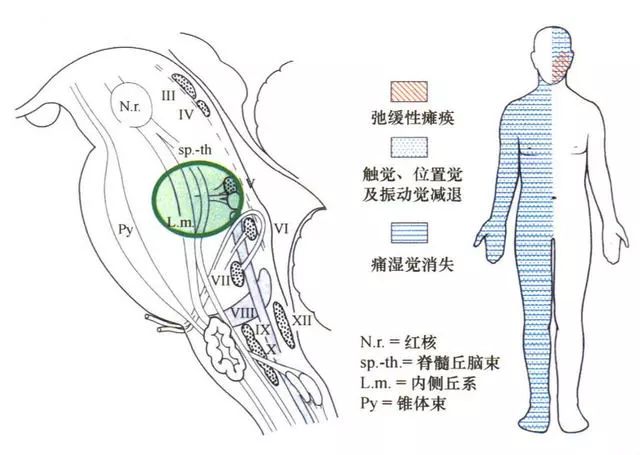 影像PPT - 10大常见脑干综合征-19 影像PPT - 10大常见脑干综合征-19