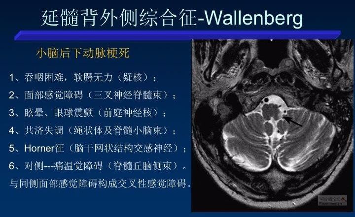 影像PPT - 10大常见脑干综合征-22 影像PPT - 10大常见脑干综合征-22