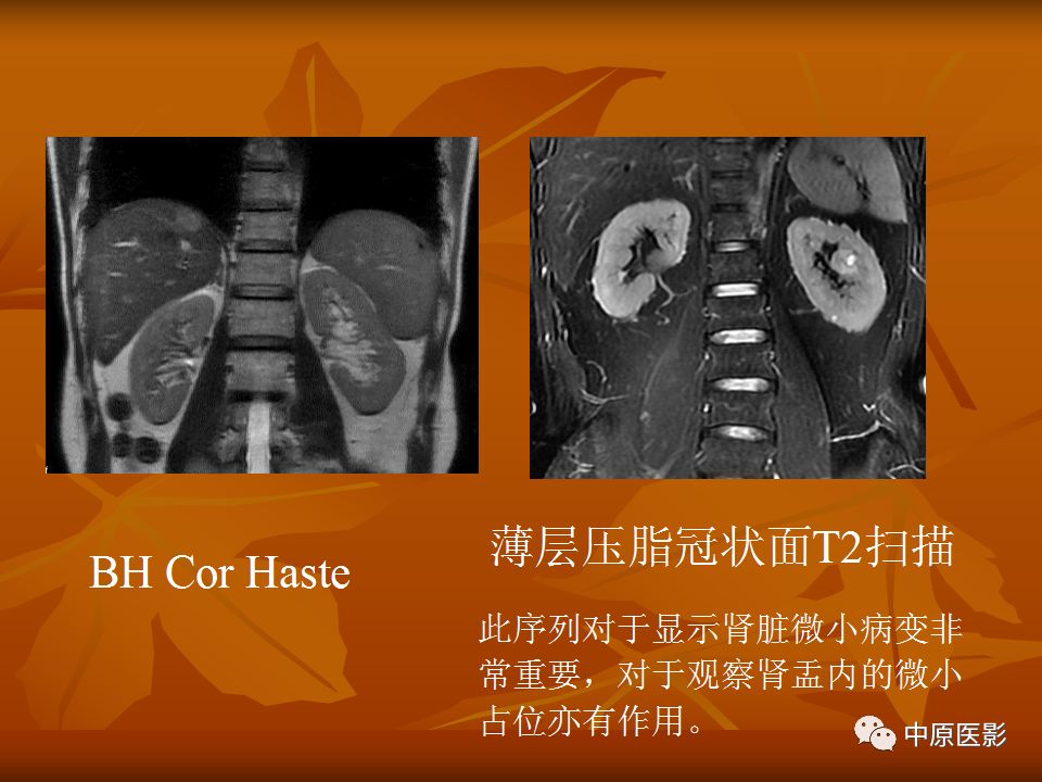 影像PPT - 【PPT】常规MRI检查在肾脏疾病中的应用-7