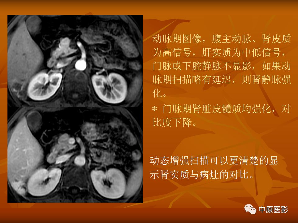 影像PPT - 【PPT】常规MRI检查在肾脏疾病中的应用-8