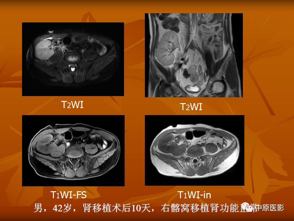 影像PPT - 【PPT】常规MRI检查在肾脏疾病中的应用-12