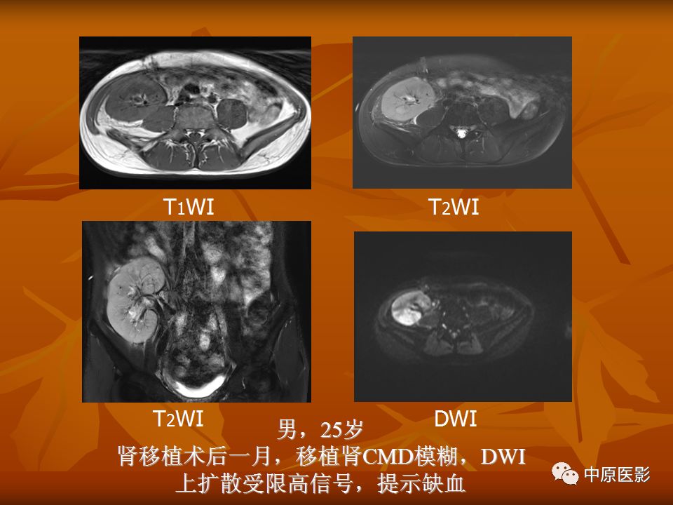 影像PPT - 【PPT】常规MRI检查在肾脏疾病中的应用-13