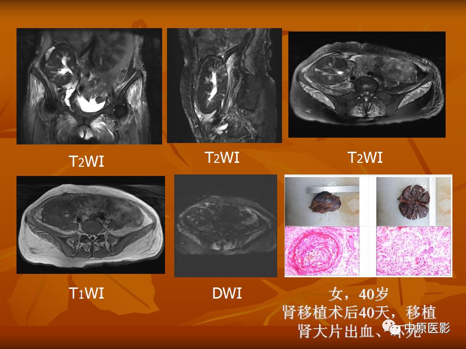 影像PPT - 【PPT】常规MRI检查在肾脏疾病中的应用-14