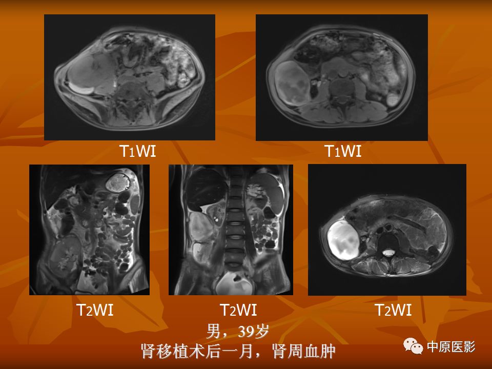 影像PPT - 【PPT】常规MRI检查在肾脏疾病中的应用-15