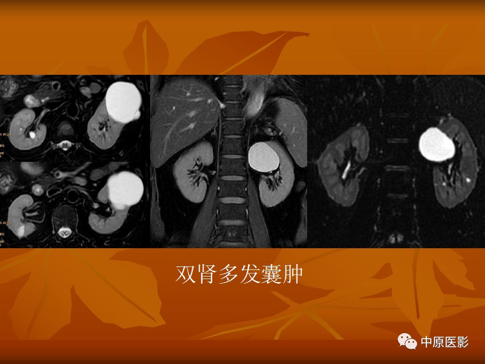 影像PPT - 【PPT】常规MRI检查在肾脏疾病中的应用-20