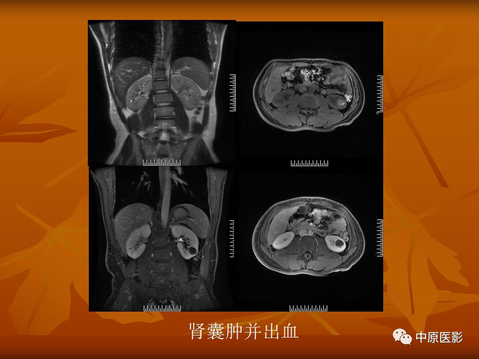 影像PPT - 【PPT】常规MRI检查在肾脏疾病中的应用-22