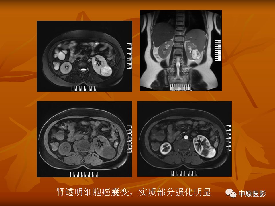 影像PPT - 【PPT】常规MRI检查在肾脏疾病中的应用-29