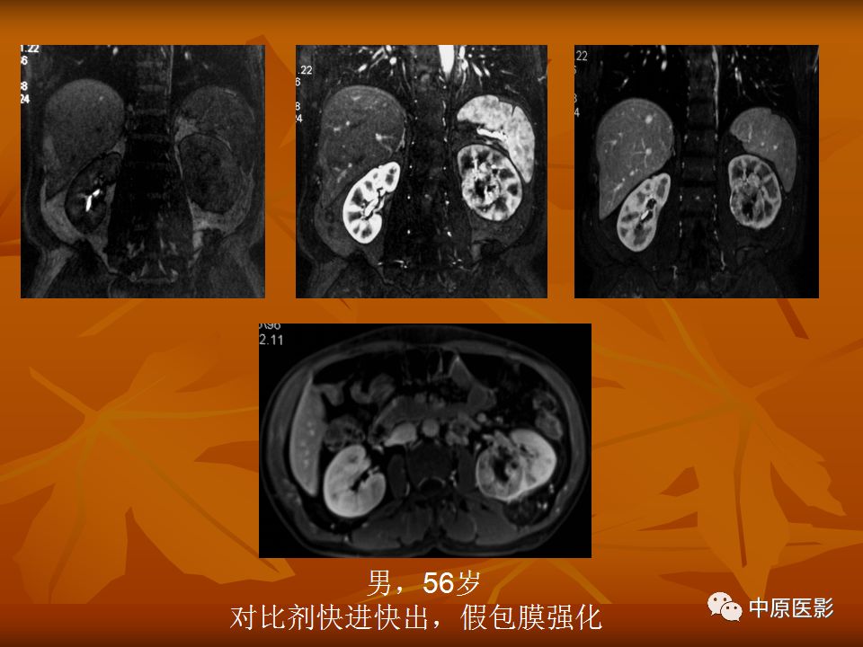 影像PPT - 【PPT】常规MRI检查在肾脏疾病中的应用-31