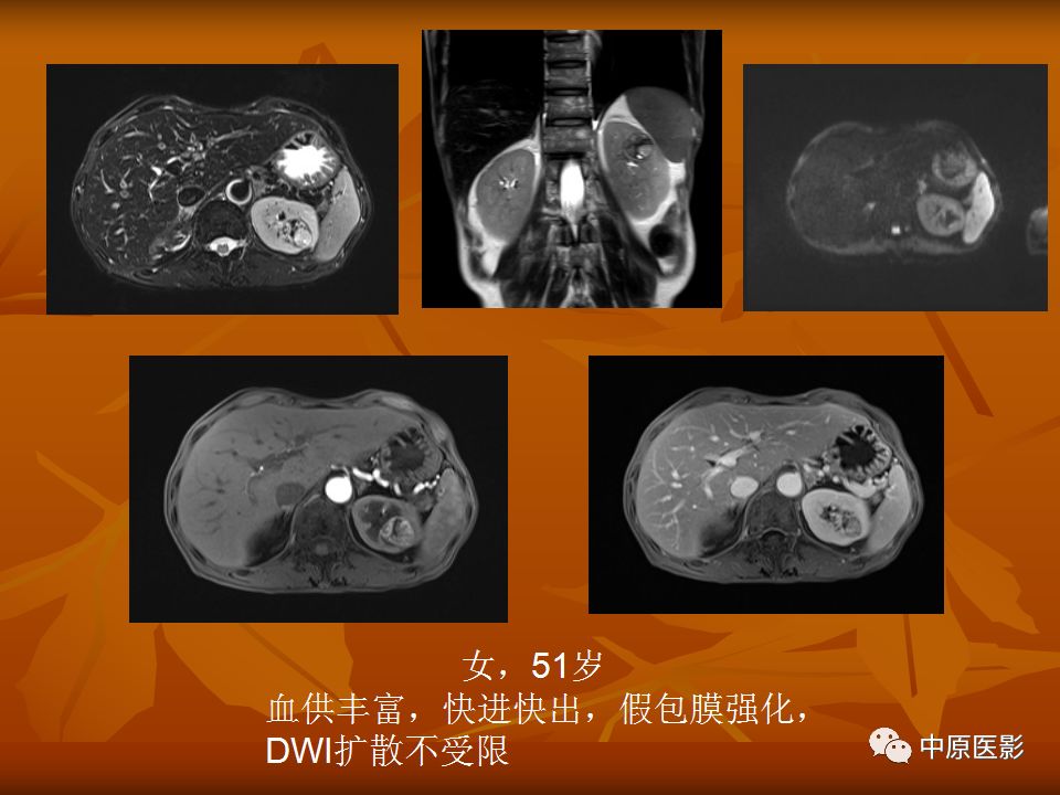 影像PPT - 【PPT】常规MRI检查在肾脏疾病中的应用-32