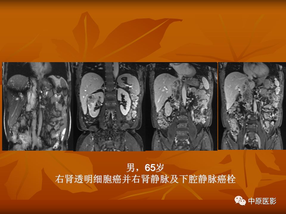 影像PPT - 【PPT】常规MRI检查在肾脏疾病中的应用-34