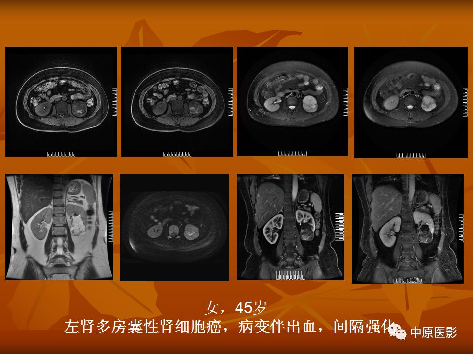 影像PPT - 【PPT】常规MRI检查在肾脏疾病中的应用-36