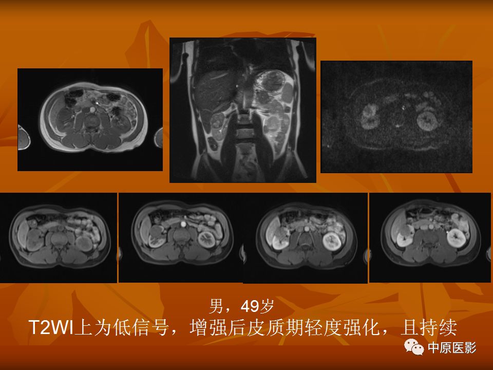 影像PPT - 【PPT】常规MRI检查在肾脏疾病中的应用-38