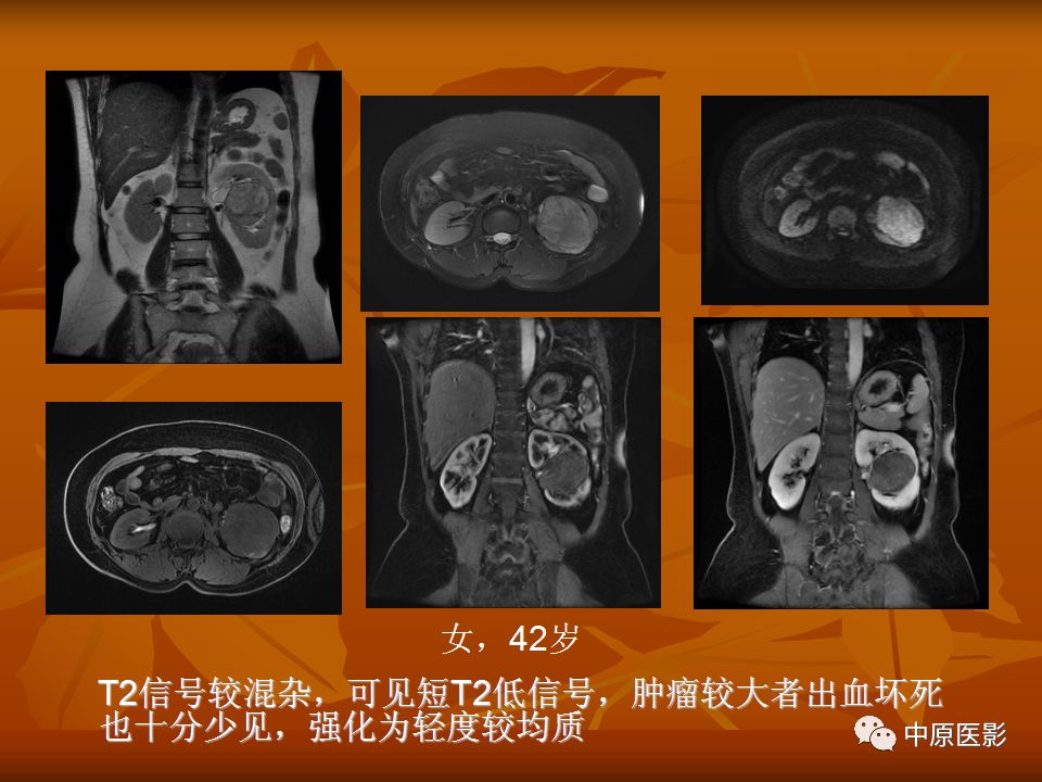 影像PPT - 【PPT】常规MRI检查在肾脏疾病中的应用-41