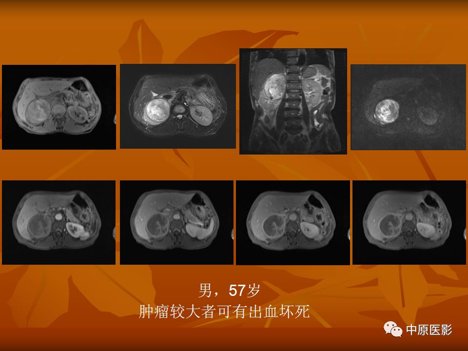影像PPT - 【PPT】常规MRI检查在肾脏疾病中的应用-39
