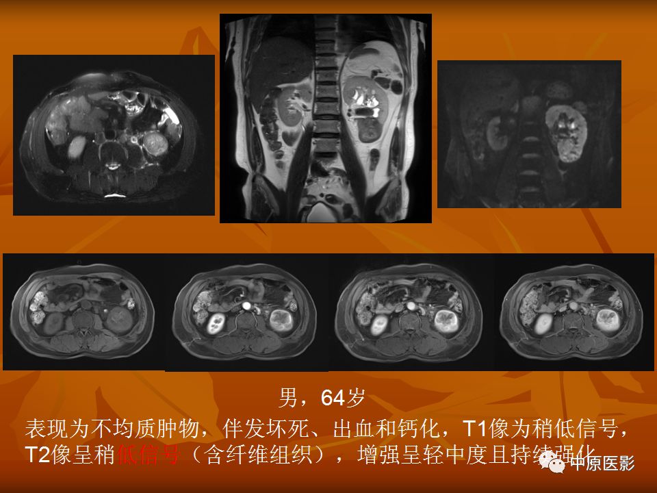 影像PPT - 【PPT】常规MRI检查在肾脏疾病中的应用-43