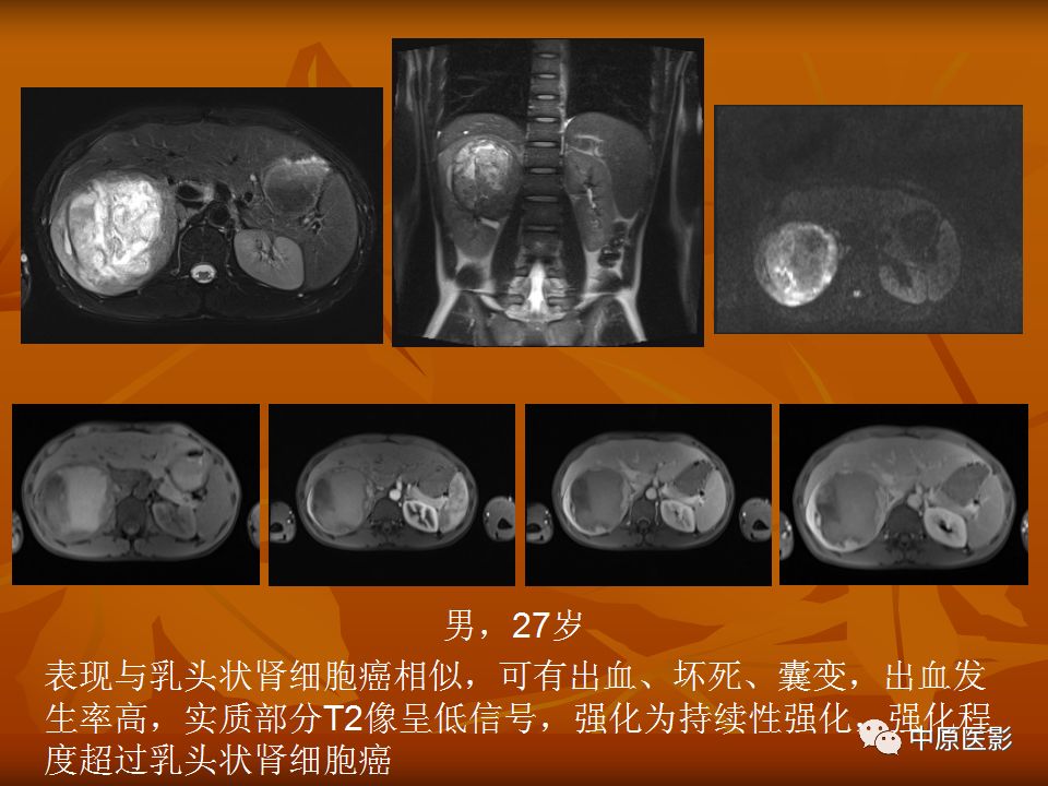 影像PPT - 【PPT】常规MRI检查在肾脏疾病中的应用-45