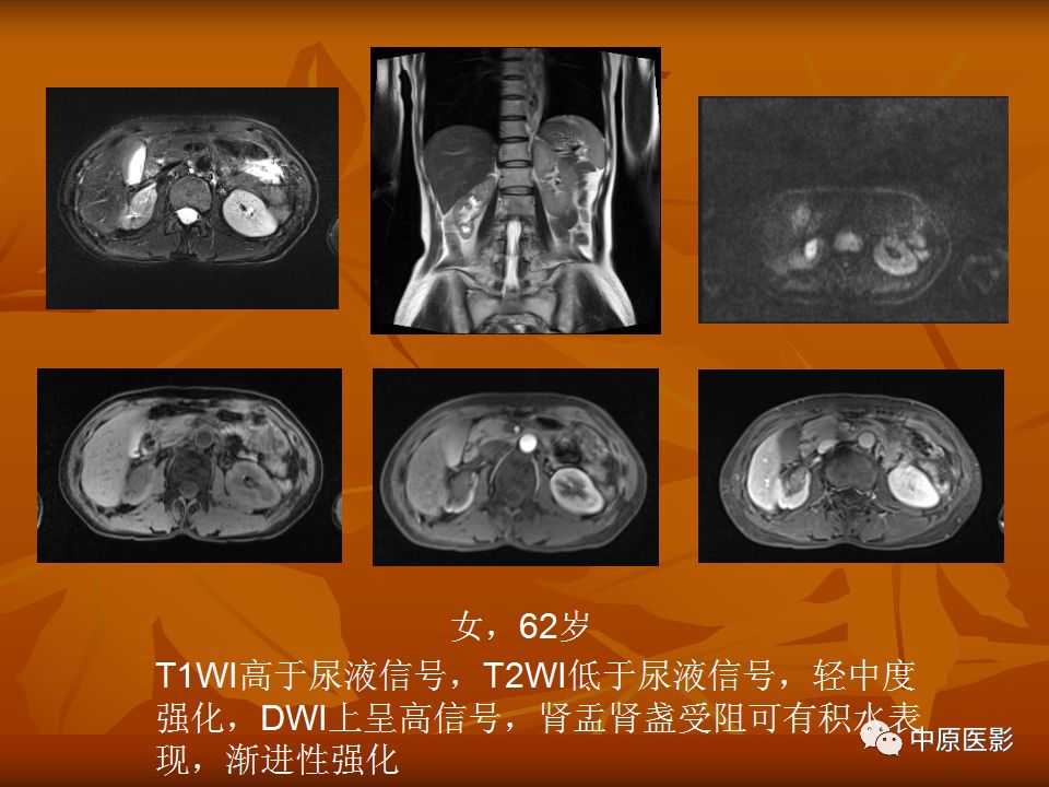 影像PPT - 【PPT】常规MRI检查在肾脏疾病中的应用-48