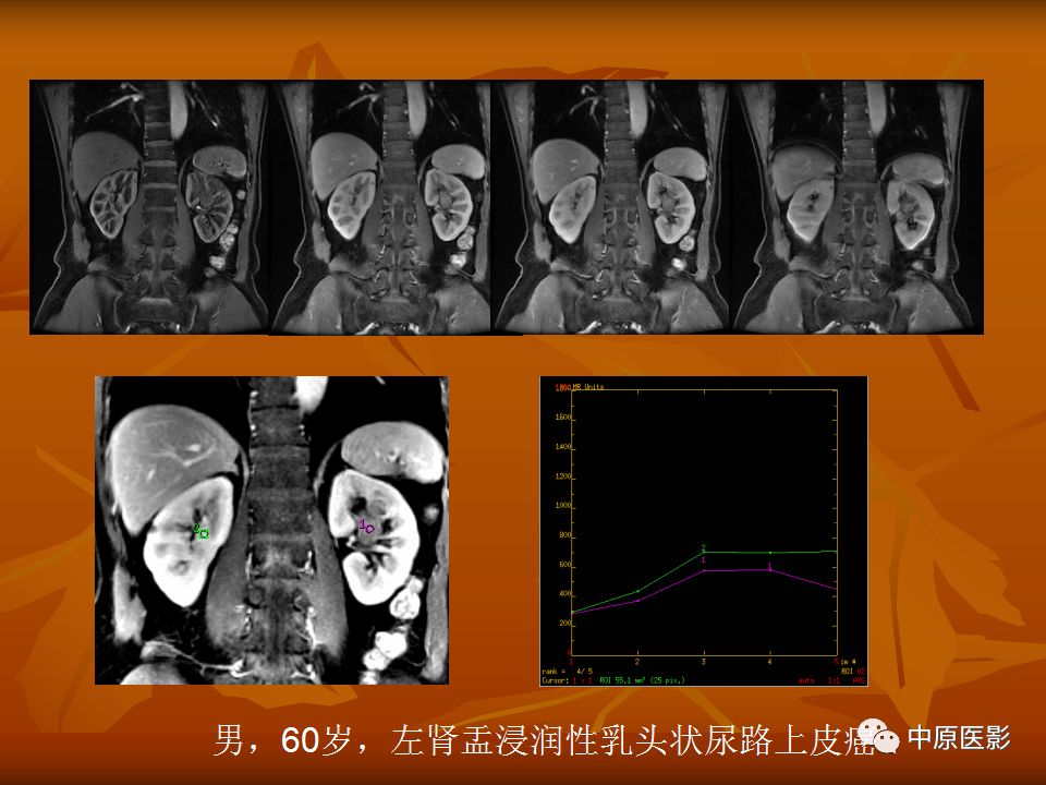 影像PPT - 【PPT】常规MRI检查在肾脏疾病中的应用-50