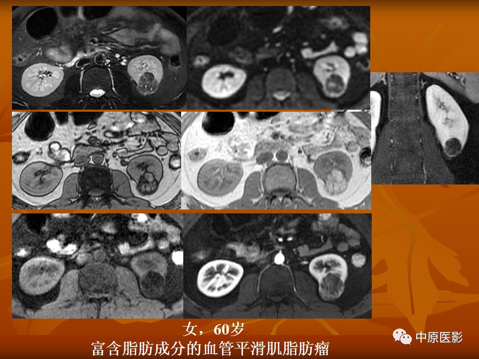 影像PPT - 【PPT】常规MRI检查在肾脏疾病中的应用-54