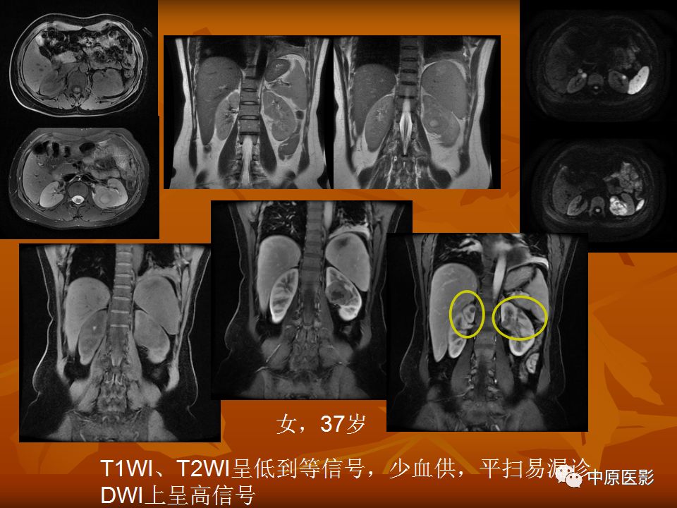 影像PPT - 【PPT】常规MRI检查在肾脏疾病中的应用-52