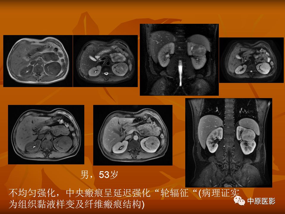 影像PPT - 【PPT】常规MRI检查在肾脏疾病中的应用-56
