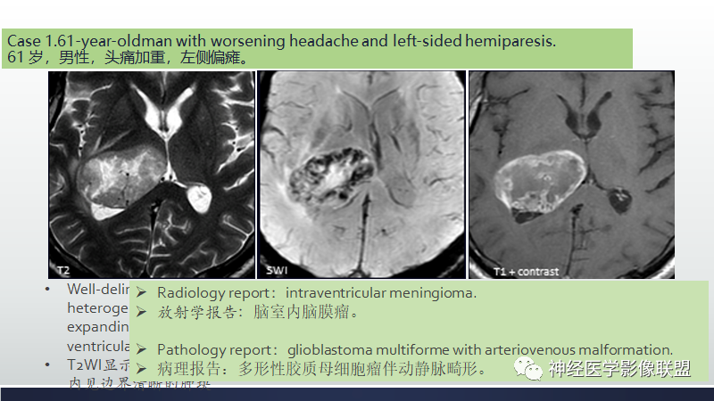 影像PPT - 【PPT】脑肿瘤和肿瘤样病变中的遗漏、误解和误导性影像征象-3