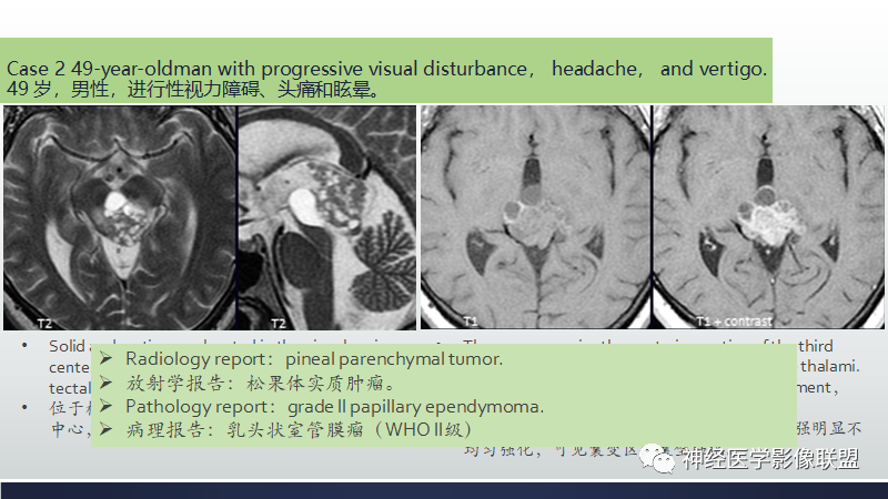 影像PPT - 【PPT】脑肿瘤和肿瘤样病变中的遗漏、误解和误导性影像征象-6