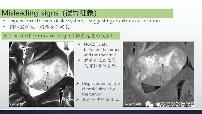 影像PPT - 【PPT】脑肿瘤和肿瘤样病变中的遗漏、误解和误导性影像征象-4