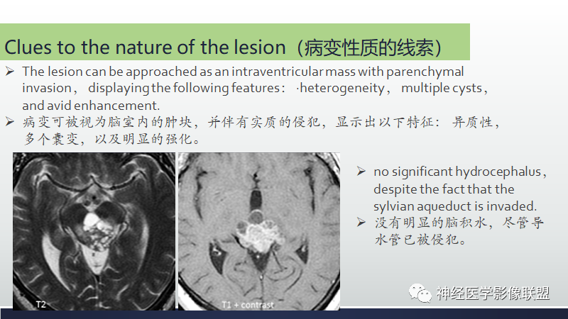 影像PPT - 【PPT】脑肿瘤和肿瘤样病变中的遗漏、误解和误导性影像征象-8